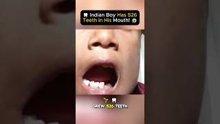 🦷 Indian Boy Has 526 Teeth in His Mouth 😱 [upl. by Madelaine734]