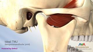 TMJ Disorder or TMD  Clicking and Closed Lock [upl. by Sharleen]