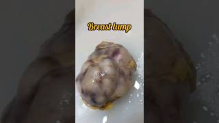 Breast lump excision biopsy for histopathology😨 breastcancer breastdisease breastfeeding lump [upl. by Obeded]