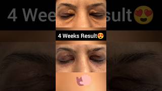 Xanthelasma Removal Before After  Xanthelasma Laser Removal Before and After [upl. by Annehcu]