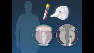 PSA and MRI Prostate Cancer Screening  NEJM [upl. by Annis]