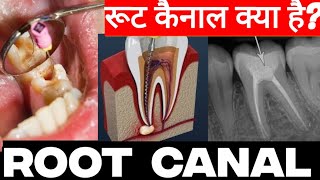 Root Canal Treatment Explained Hindi Step by step 🪜dentalcare dentist rootcanaltreatment [upl. by Eul]