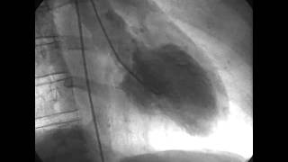 Procedural Coronary Angiography of Coronary Artery Thrombus Aspiration Followed by Bolus Intracorona [upl. by Roosevelt475]