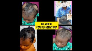 CephalohematomaCephalohematoma in newbornsBilateral cephalohematomaHead swelling in infant [upl. by Ellirpa]