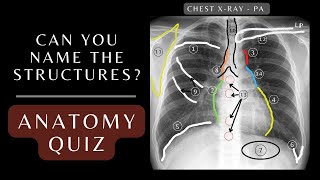 Chest Xray Anatomy Quiz Questions and Answers  Chest Xray Anatomy xray respiratory [upl. by Annaihs]