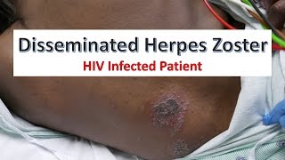 Disseminated Herpes Zoster Infection in an HIV Patient [upl. by Neuburger]