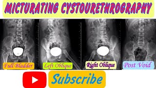 Micturating Cystourethrography  MCU  VCUG Micturatingcystourethrogram MCUradiology MCU [upl. by Perry562]