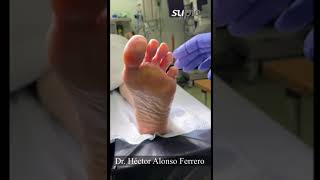 Dr Héctor Alonso Ferrero Cirugía metatarsalgia Dolor plantar [upl. by Cinamod]