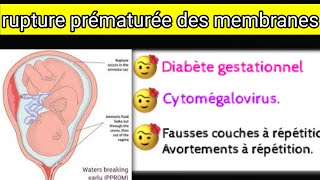 rupture prématurée des membranes [upl. by Dahc]