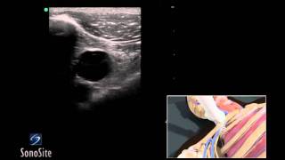 How To Ultrasound Guided Insertion of a Subclavian Vein Catheter 3D Video [upl. by Alyehc]