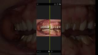 Invisalign Time Lapse Video [upl. by Emeline]