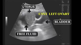 SIMPLE OVARIAN CYST RUPTURED DURING ULTRASOUND [upl. by Ayin]