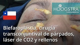 Blefaroplastía cirugía transconjuntival de párpados láser de CO2 y rellenos 17053 [upl. by Prussian797]