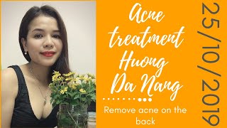 Acne treatment Hương Đà NẵngRemove acne on the back 25102019 [upl. by Marnia]