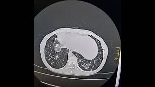 KartagenerAfzelius syndrome a subset of Primary ciliary dyskinesia [upl. by Nileek]