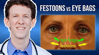 What Are Eye Festoons vs Lower Eyelid Bags [upl. by Seana]