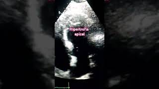 Hipoquinesia apical echocardiogram [upl. by Branch910]