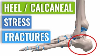 HeelCalcaneal Stress Fracture Causes Symptoms amp Treatment [upl. by Hong]