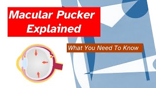 What You Need To Know About Macular Pucker Symptoms Treatment and More [upl. by Nilde]