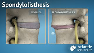 Spondylolisthesis [upl. by Ainyt]