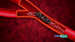 Froedtert amp MCW Stroke Treatment [upl. by Tartan]