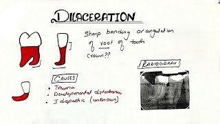 dilaceration dental  dilaceration  Developmental Disturbance of Teeth [upl. by Clarita]