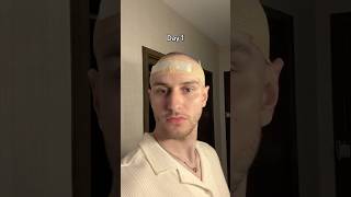 1 month post hair transplant hair hairtransplant hairtransformation hairgrowth update [upl. by Baillieu]