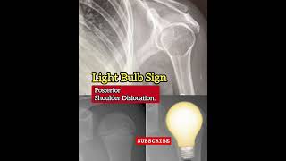 The Light Bulb Sign  Posterior shoulder dislocation  X Ray  Basic Radiology [upl. by Ecirrehs]