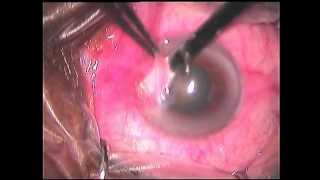 Pterygium Excision with AMG [upl. by Uhsoj]