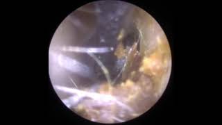 Gentle ear wax removal with Jobson Horne Probe [upl. by Ahsiemat]