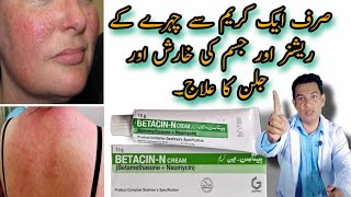 face rashes cream  body rashes cream  betacin n cream  betamethasone  how to treat skin redness [upl. by Sapphira]