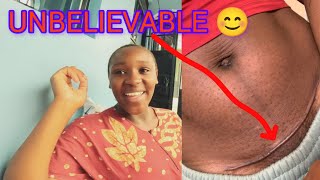 UNBELIEVABLE‼️ UPDATE ON MY WIFES WOUND AFTER CESAREAN SECTION AND OUR BABY PRINCESS [upl. by Imugem]