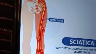 sciatica streching nerve exercise amp Sciatica pain relief exercise [upl. by Hazmah]