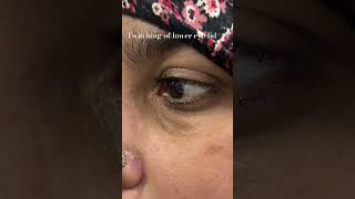 Twitching of lower eye lideyelid myokymia [upl. by Nerred326]