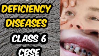 Deficiency diseases class 6 CBSE [upl. by Alberta]