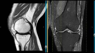 Mucoid degeneration of lateral meniscus in 86 year old [upl. by Campney398]