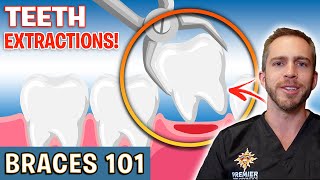 BRACES 101 Tooth Extractions For Braces  Treatment Minute Talk [upl. by Nodnil]