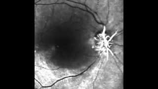 Central Retinal Artery Occlusion [upl. by Ricardo]