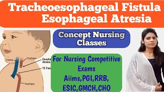 Tracheoesophageal Fistula and Esophageal Atresia pediatrics important topic [upl. by Adnalohs]