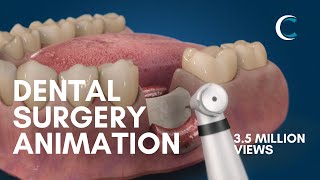 Dental Surgery Animation  Bone Grafting [upl. by Friede]