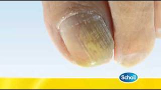 Fungal Nail Condition by Scholl [upl. by Kristien]