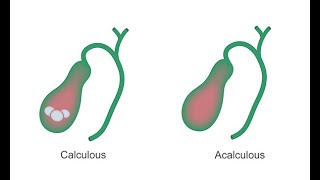 Identifying acute cholecystitis [upl. by Hertz272]