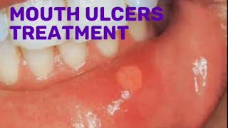 Drugs for mouth ulcers treatment pharmacist pharmacy [upl. by Thormora]