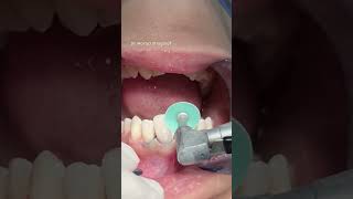 Dental composite veneer satisfying [upl. by Rutter718]