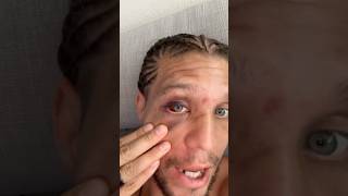 🙏👁️ BRIAN ORTEGA REACTS AND GIVES A HEALTH UPDATE AFTER LOSS TO DIEGO LOPES AT NOCHE UFC [upl. by Neeloj]