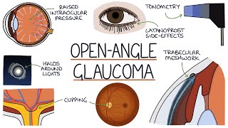 Understanding Open Angle Glaucoma [upl. by Sirred]