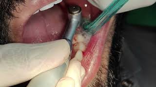 Lower left side first molar implant placement [upl. by Dorri]