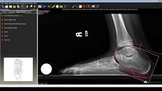 Foot and Ankle Deformity Correction with Dr Noman Siddiqui  Flat foot Deformity [upl. by Gibbon300]