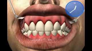 Why gums bleed  what is Gingivitis [upl. by Boffa118]