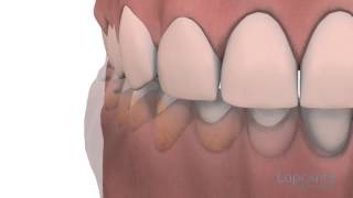 Gingivoplastie et gingivectomie  Centres dentaires Lapointe [upl. by Hcaz]